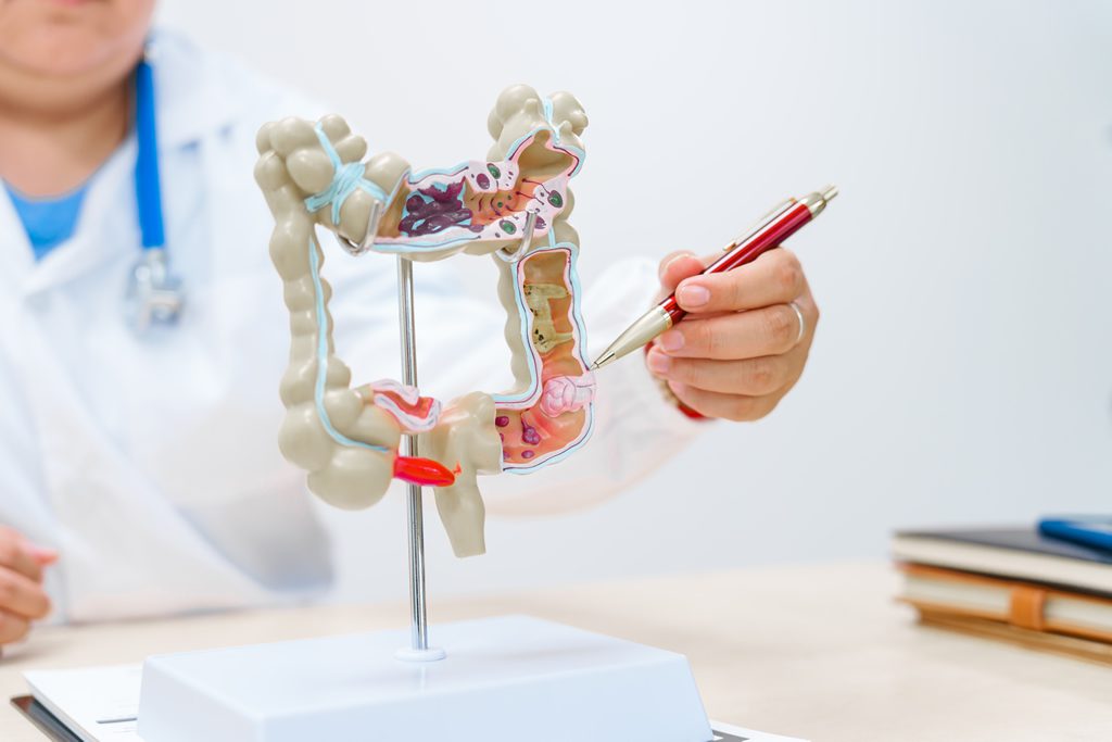 Câncer no Cólon Sigmoide: O que Significa Quando o Tumor está no Lado Esquerdo