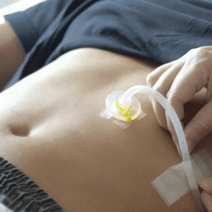 Gastrostomia e Jejunostomia