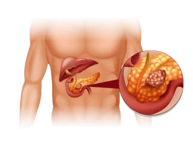 Tratamento de tumor neuroendócrino em Santos