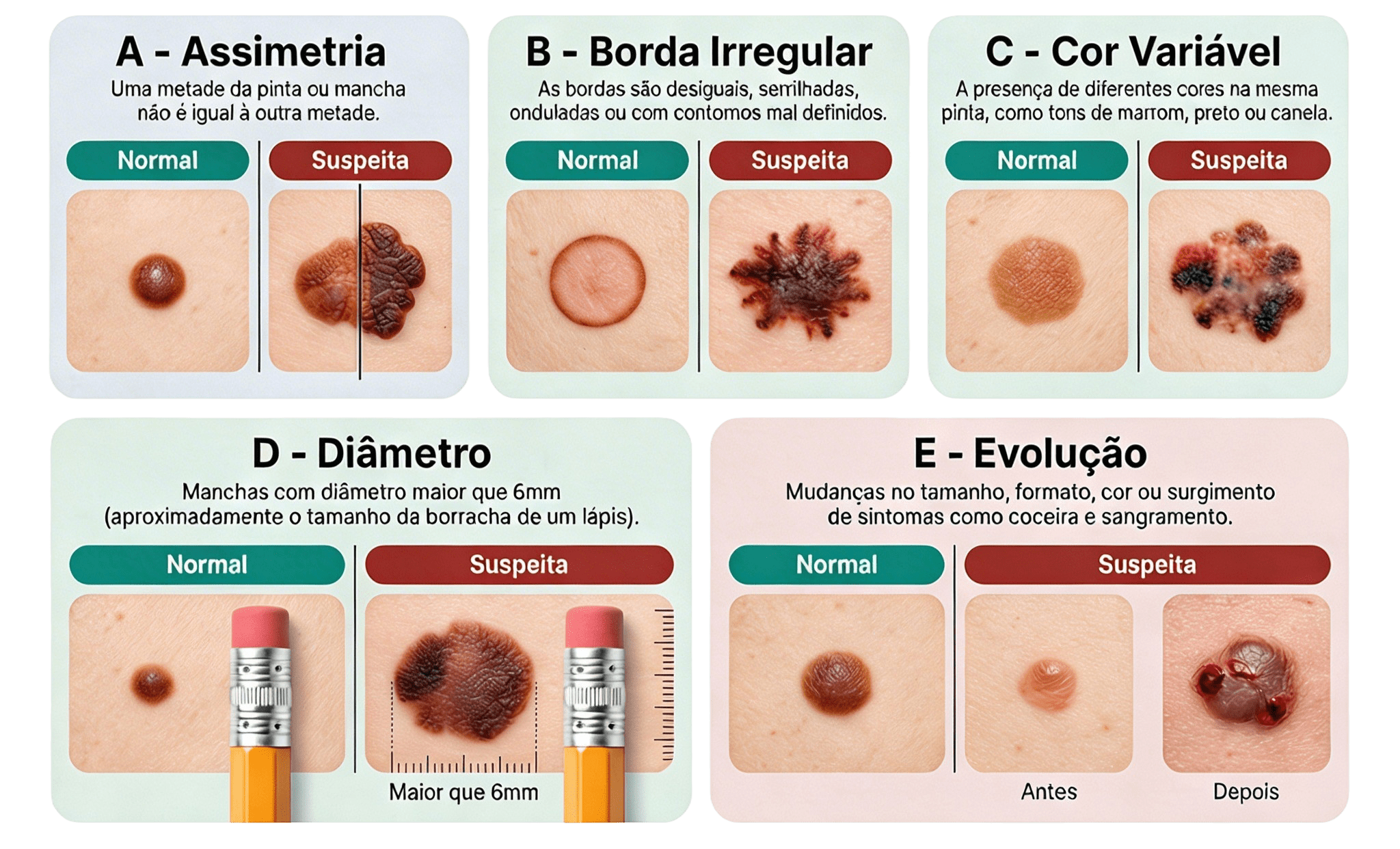 Infográfico com identificação de pintas suspeitas através da Regra ABCDE: Assimetria, Borda irregular, Cor variável, Diâmetro maior que 6 mm e Evolução da lesão.