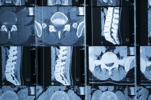 Compressão medular neoplásica