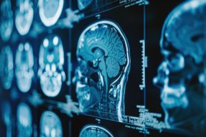 Inchaço no cérebro por metástase