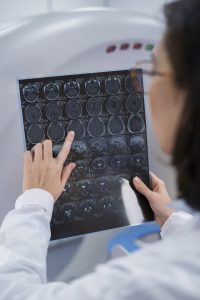 metástase cerebral de melanoma