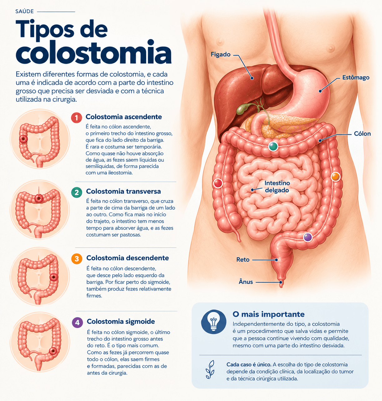 Infográfico dos tipos de colostomia pelo local no cólon: ascendente, transversa, descendente e sigmoide, com a posição de cada estoma.