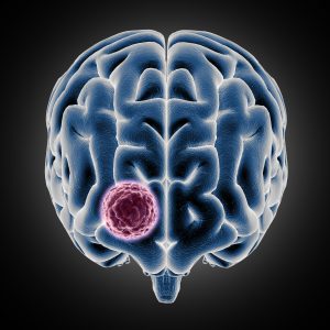 Glioma