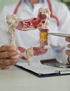 Cirurgia do Câncer de Cólon