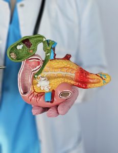 Cirurgia de Whipple no câncer de pâncreas