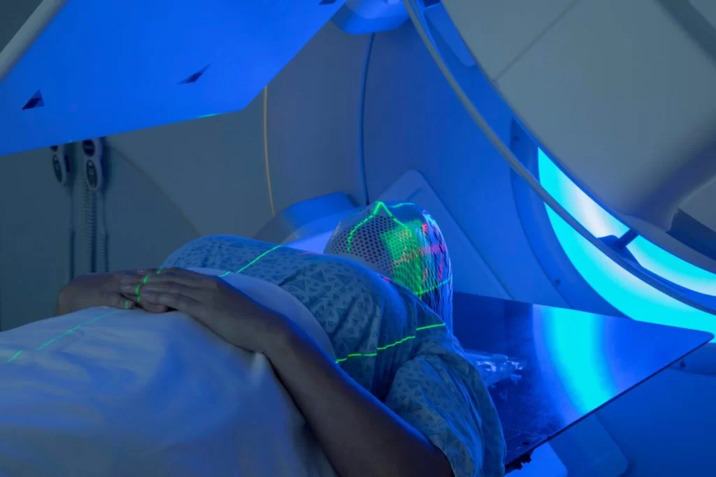 radioterapia tumor cerebral glioblastoma IMRT sessões tratamento