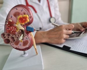 Sinais de alerta do câncer de rim