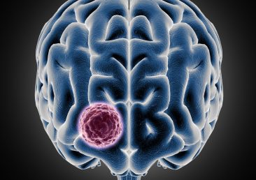 3D render of a medical image showing brain with tumor growing