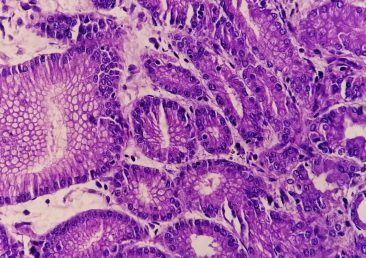 Adenocarcinoma ao microscópio, com células tumorais formando estruturas semelhantes a glândulas