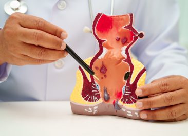 Asian doctor with rectum and hemorrhoid human anatomy model at hospital, inflamed vascular structure.