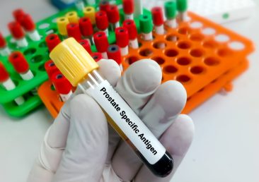 blood-sample-prostate-specific-antigen-psa-test-diagnosis-prostate-cancer