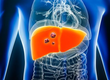 Câncer de Fígado: Sintomas, Causas, Tipos e Tratamentos Completos