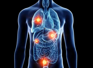 Câncer Metastático: Entendendo Quando a Doença Se Espalha
