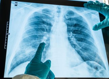 biópsia de nódulo pulmonar