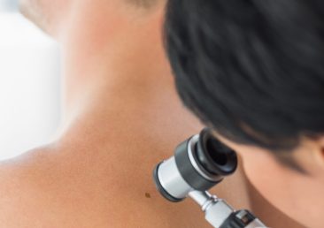 Female doctor examining melanoma with dermoscope on back of man