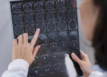metástase cerebral de melanoma