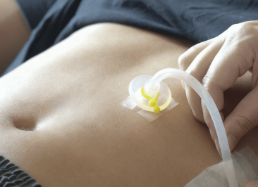 Gastrostomia e Jejunostomia