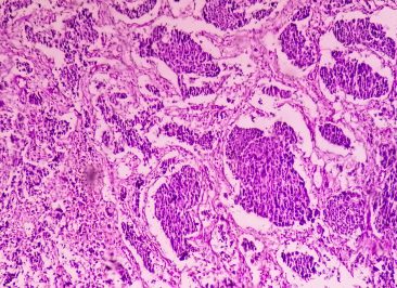 Tumor Neuroendócrino é Benigno ou Maligno