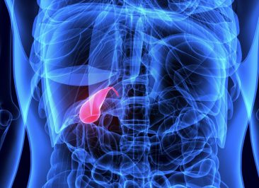 Câncer de Vesícula Biliar