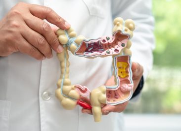 Diverticulite: Qual a relação com câncer colorretal