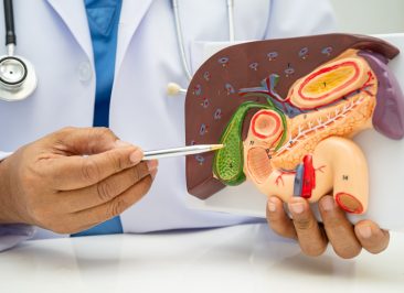 Câncer de Vesícula Biliar