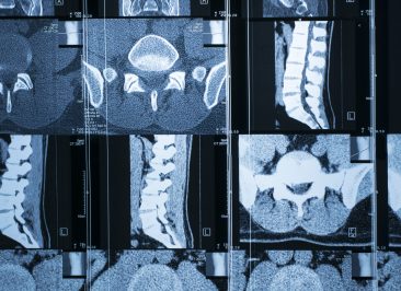 Compressão medular neoplásica