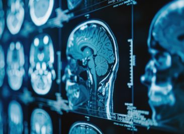 Inchaço no cérebro por metástase