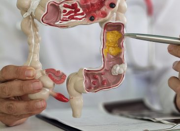 Cirurgia do Câncer de Cólon