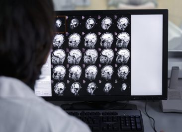 Câncer de Cérebro: Sintomas, Tipos e Novos Tratamentos