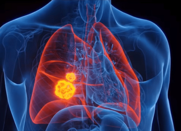 Tomografia computadorizada de tórax com nódulo pulmonar metastático