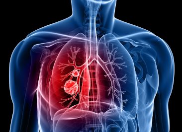 Nódulo no Pulmão: quando se preocupar e o que fazer