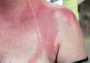 Redness and swimsuit sign on a young woman's skin caused by sun exposure. Burning caused by the sun's rays from the hottest hours of a summer day. Skin care and prevention concept.