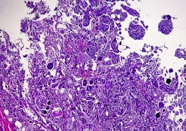 spinal-tumor-biopsy-showing-psammomatous-meningioma-psammoma-bodies
